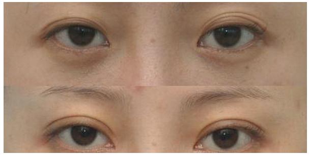 国内修复双眼皮最好的医生有哪些？