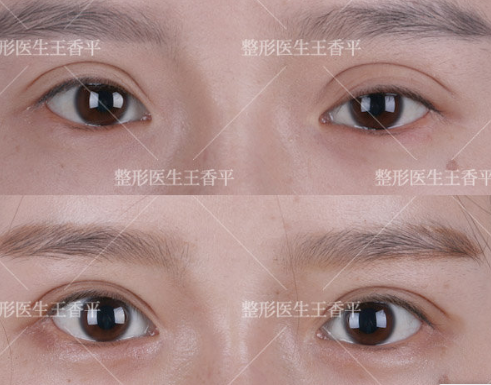 王香平做双眼皮和双眼皮修复怎么样？