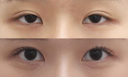 杭州眼修复最好的医生是谁？