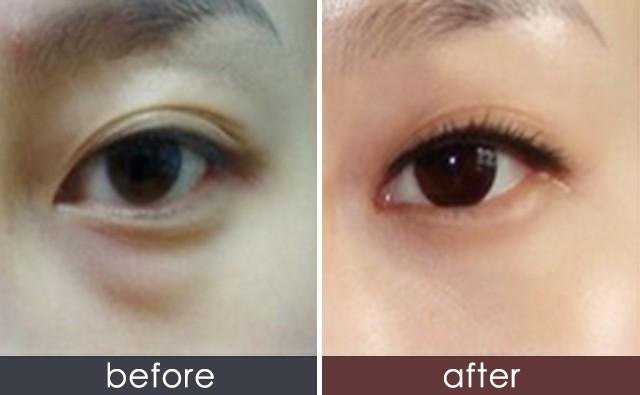 上海九院哪个医生做眼袋手术最好？