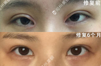 郑州眼角修复比较好的医生是谁？