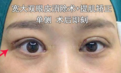 马晓飞修复双眼皮怎么样？马晓飞眼修复简介预约