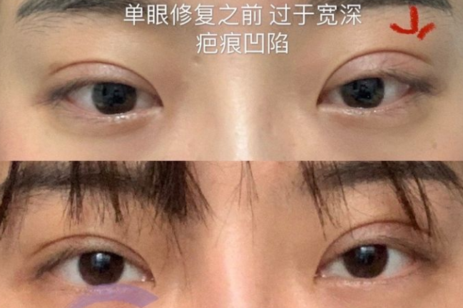南京蔡薇双眼皮和眼修复的技术怎么样？