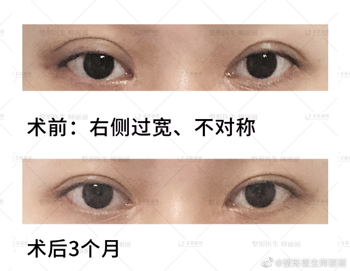 郑永生对比师丽丽哪个修复双眼皮厉害？