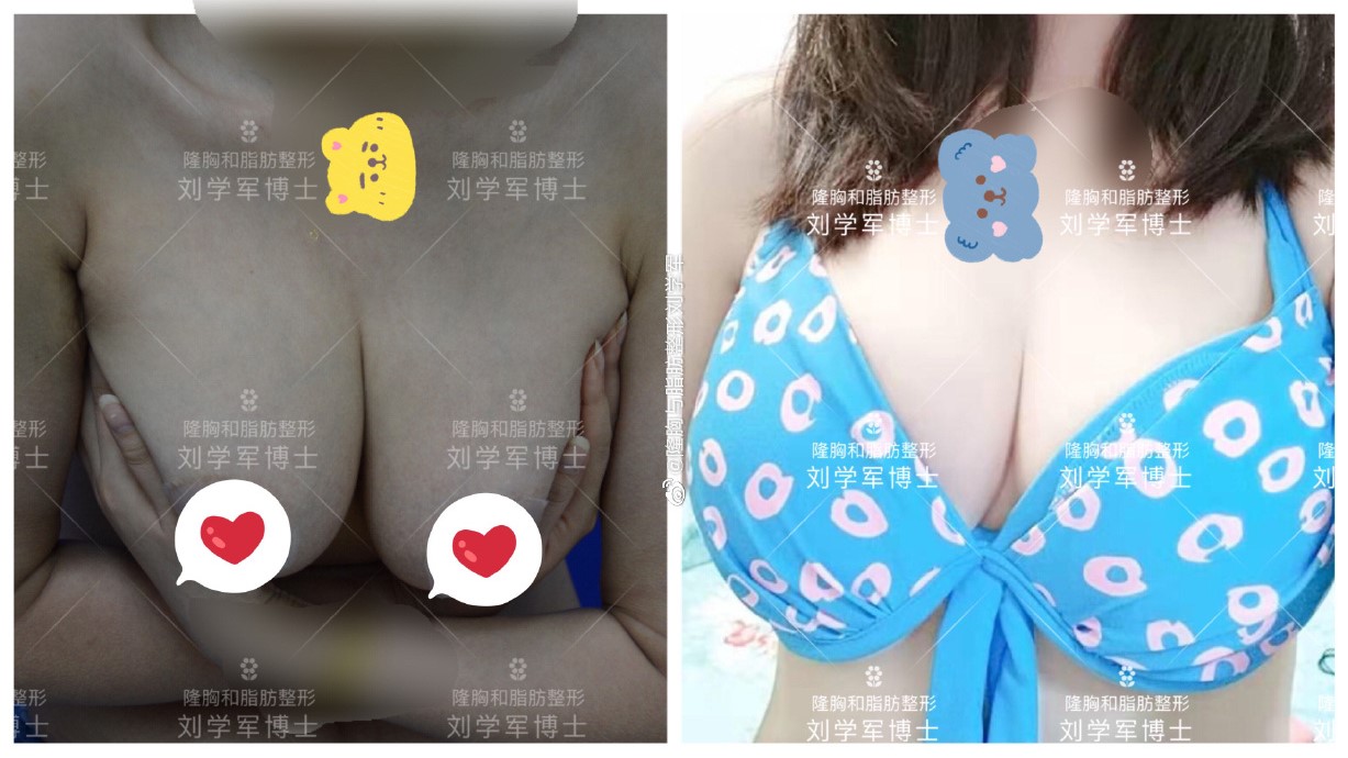 深圳刘学军脂肪丰胸技术厉害吗？