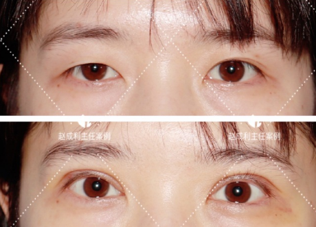 广州赵成利割双眼皮和眼修复技术好吗？