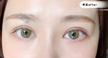 上海瑞欧医疗整形朱维玲双眼皮做得好吗？