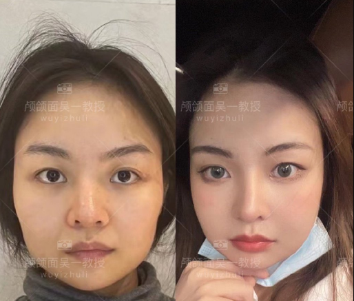 吴一医生做改脸型技术怎么样？