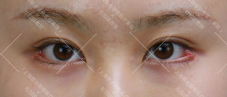 上海杜园园修复双眼皮技术评价怎么样？