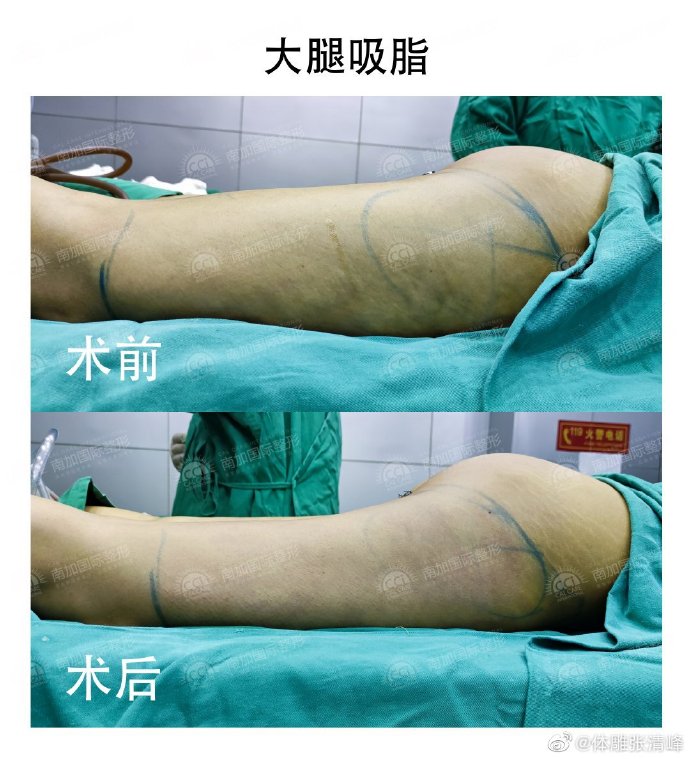 北京南加张清峰医生大腿吸脂怎么样？