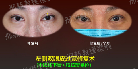 上海有名的双眼皮修复专家预约排行榜大全