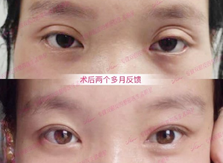 郑州修复双眼皮最好的医生都有谁？