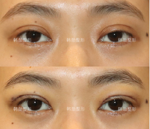 北京修复双眼皮预约最多的专家有哪些？