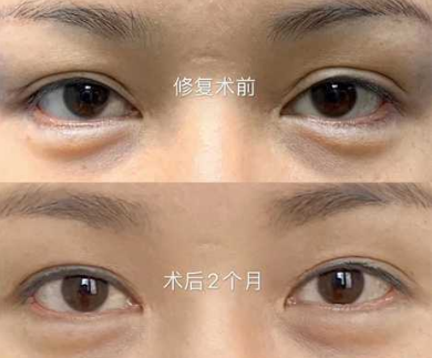 2022年长春双眼皮修复哪个医生做得好？