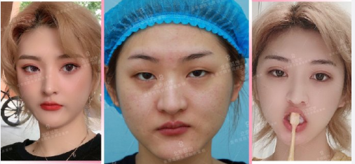 2022年北京割双眼皮最好的医生是谁？