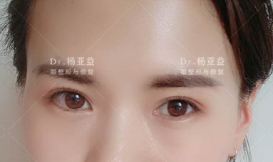2022年上海割双眼皮最好的整形医生有哪些？
