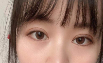 广州邹吉平修复双眼皮技术反馈怎么样？