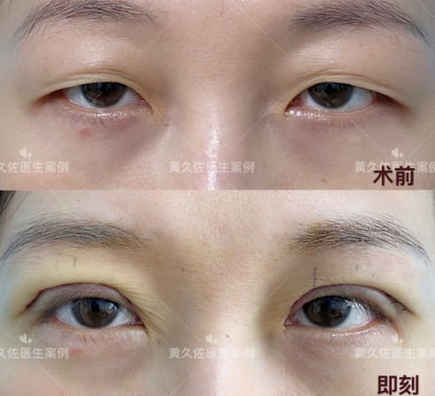 北京协和黄久佐做的双眼皮技术好吗？