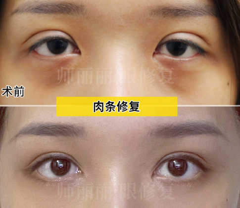 北京师丽丽双眼皮修复技术好吗？