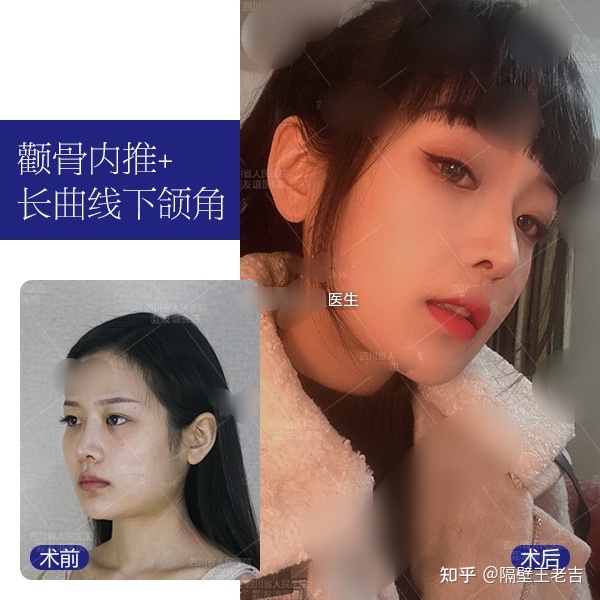 李运峰专家做下颌角手术怎么样？