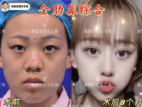 2022年上海最权威鼻子整形医生有哪些？