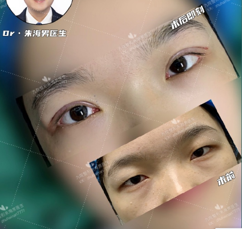2022年上海九院哪个医生割双眼皮的技术好？