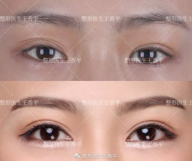 王香平做双眼皮修复案例