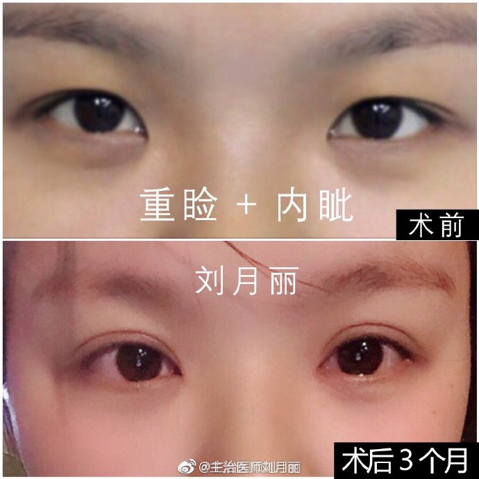郑州刘月丽割双眼皮技术怎么样？