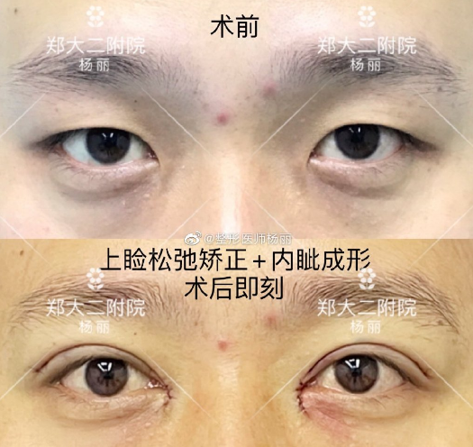 郑州双眼皮专家刘月丽和杨丽谁做双眼皮更好些？