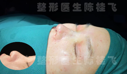 向宏伟和陈桂飞哪个医生好做鼻子技术更好？