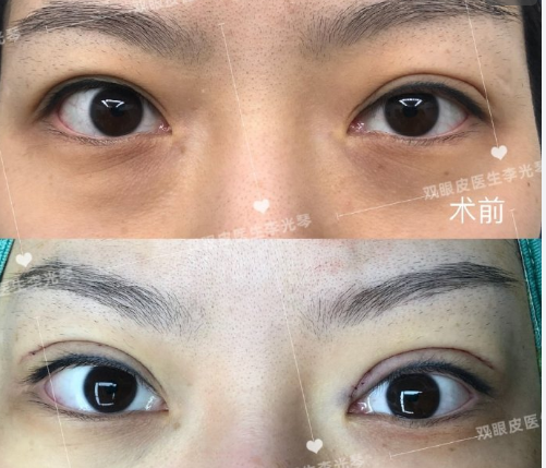 2022年东莞做修复双眼皮最好的专家有哪些？