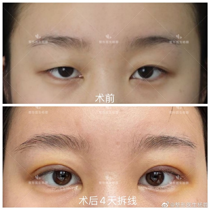 武汉武昌铁路医院杨蓉做双眼皮和修复好吗？