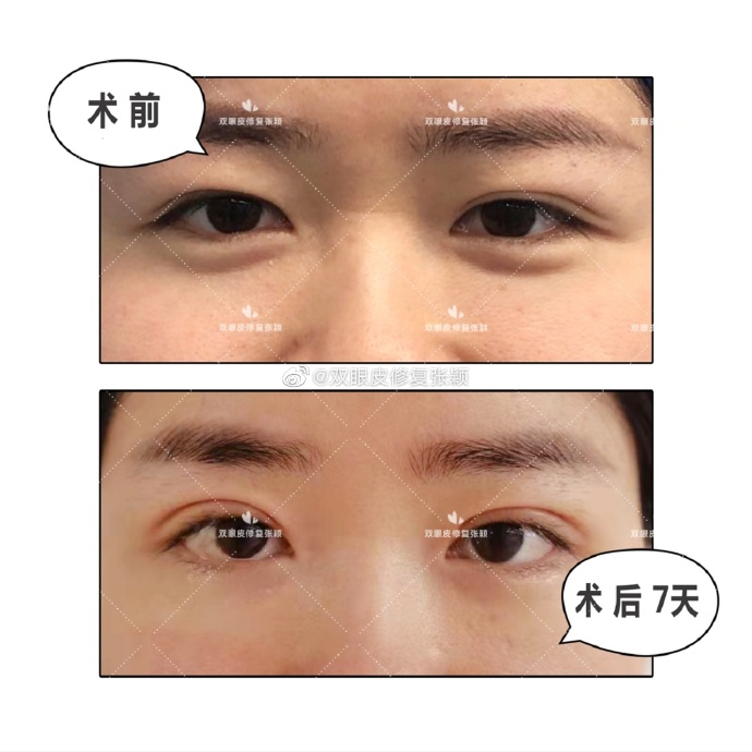 北京美莱张颖双眼皮修复技术怎么样？