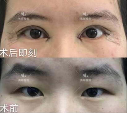 郑州亮眼贾亮做双眼皮&修复技术怎么样？