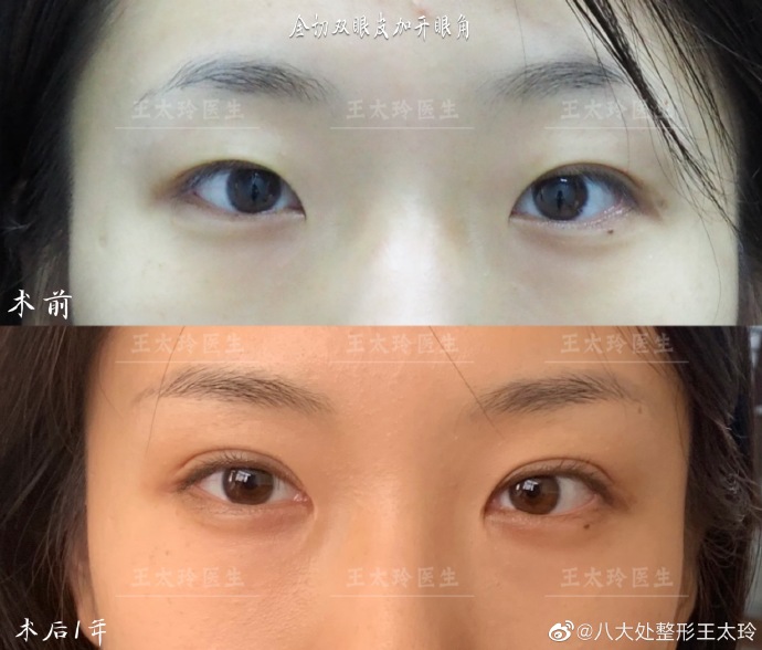 卢建建和王太玲哪个做双眼皮技术比较好？