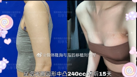 深圳隆胸专家刘学军做假体丰胸怎么样？