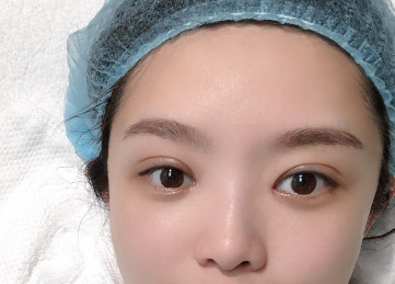 2022年天津哪个医生修复双眼皮最好？