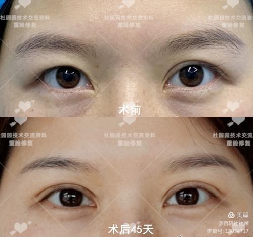上海杜园园做修复双眼皮做得怎么样？