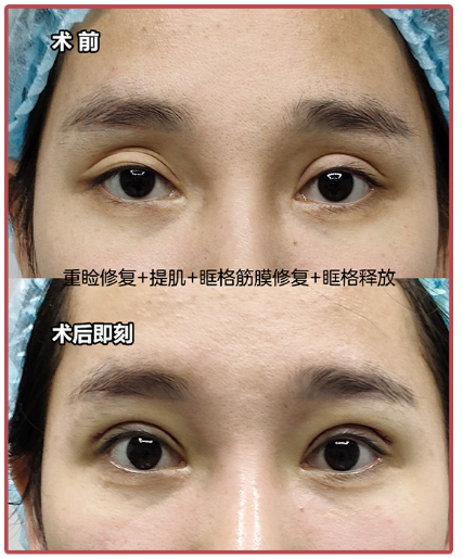 重庆刘晓伟修复双眼皮技术怎么样？