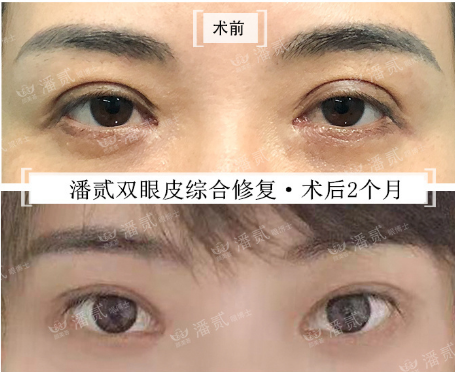 广州眼修复专家潘贰修复双眼皮怎么样？