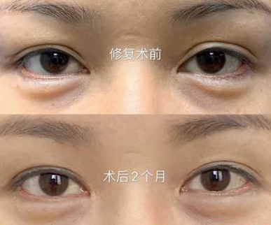 2022年郑州比较好的双眼皮修复医生是谁？
