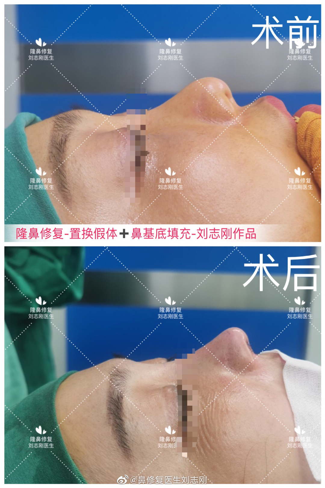 广州刘志刚做修复鼻子技术怎么样？