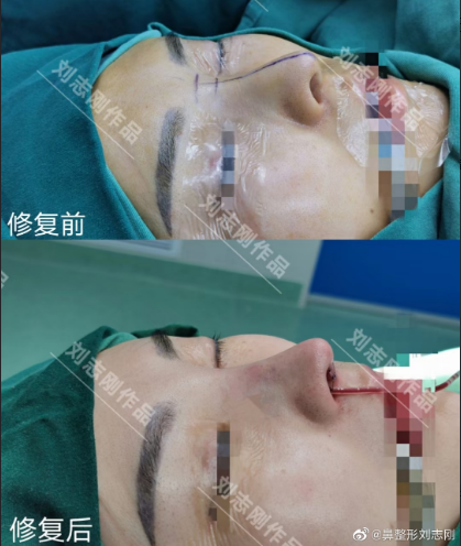 广州刘志刚做隆鼻修复技术怎么样？