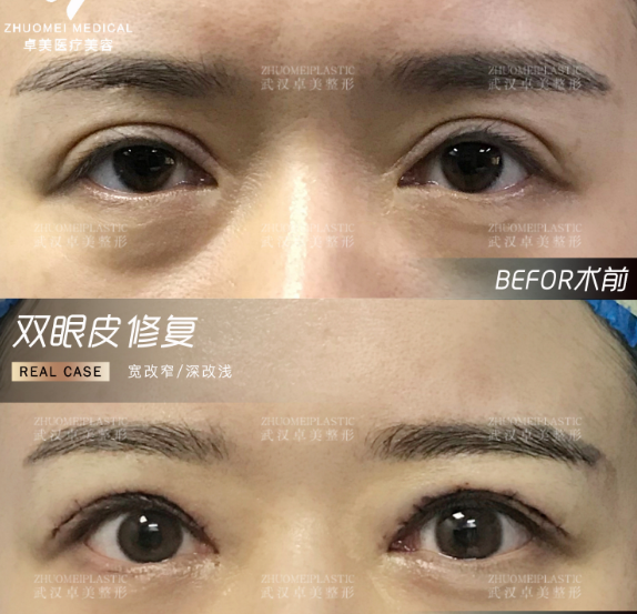 武汉王吴小蔚和海平谁做双眼皮修复最好？