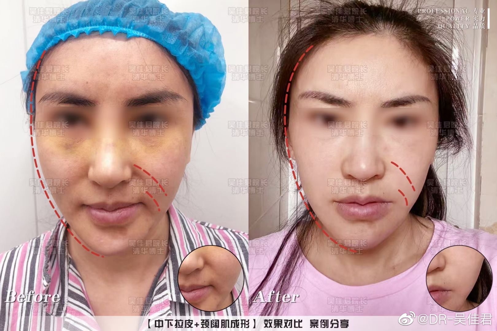 上海吴佳君医生做面部拉皮技术怎么样？
