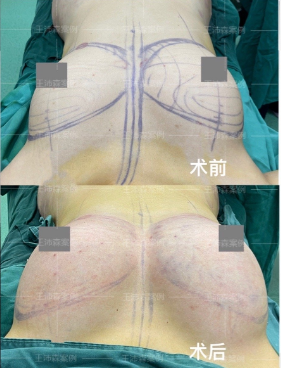 北京王沛森自体脂肪隆胸技术口碑怎么样？
