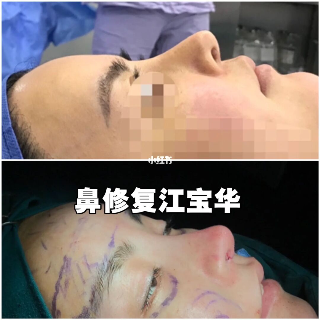 上海江寶華做鼻子&隆鼻修復技術好嗎？