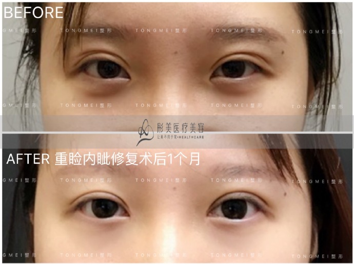 北京刘风卓修复双眼皮反馈怎么样？
