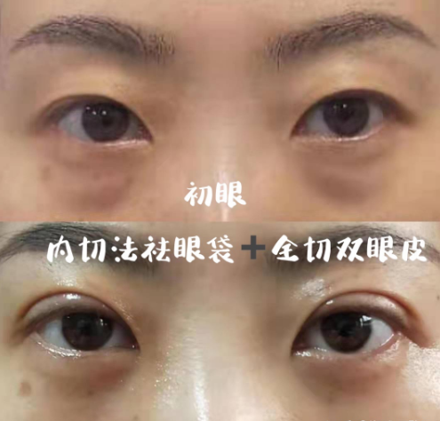 南京去眼袋手术刘宁和刘育凤谁技术好？