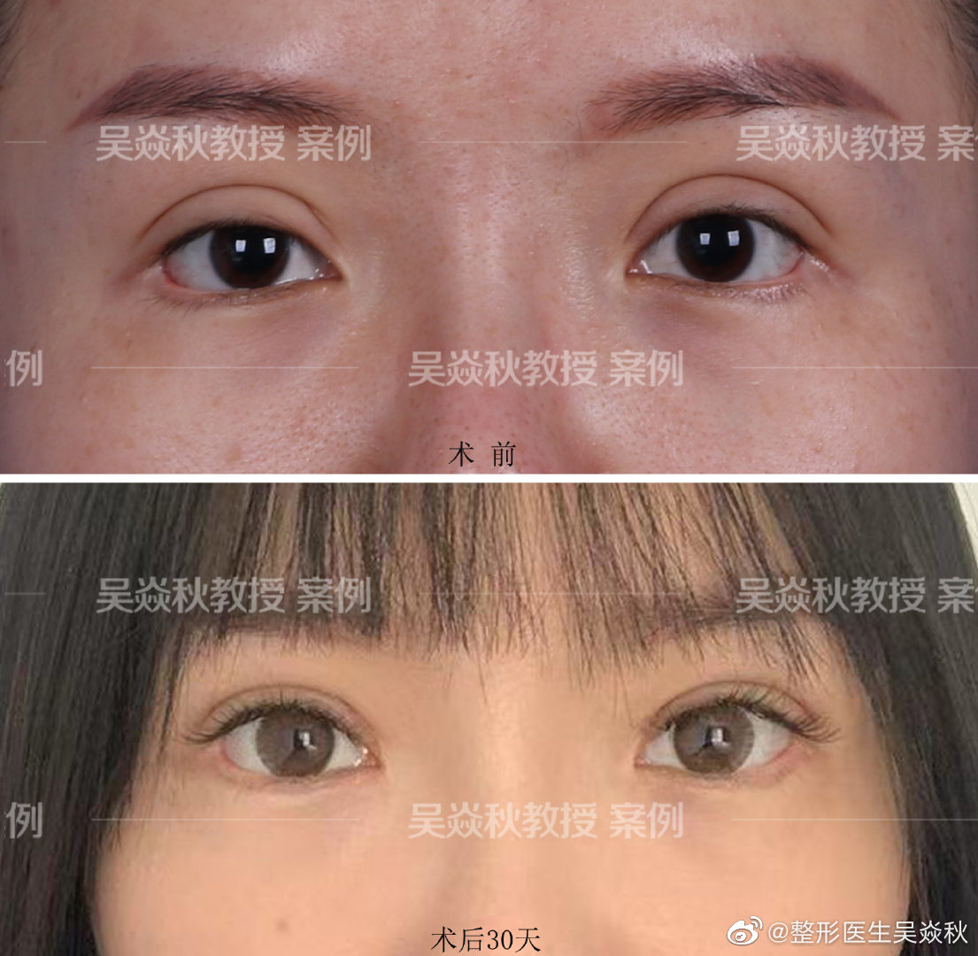 刘风卓和吴炎秋哪个修复双眼皮技术好？